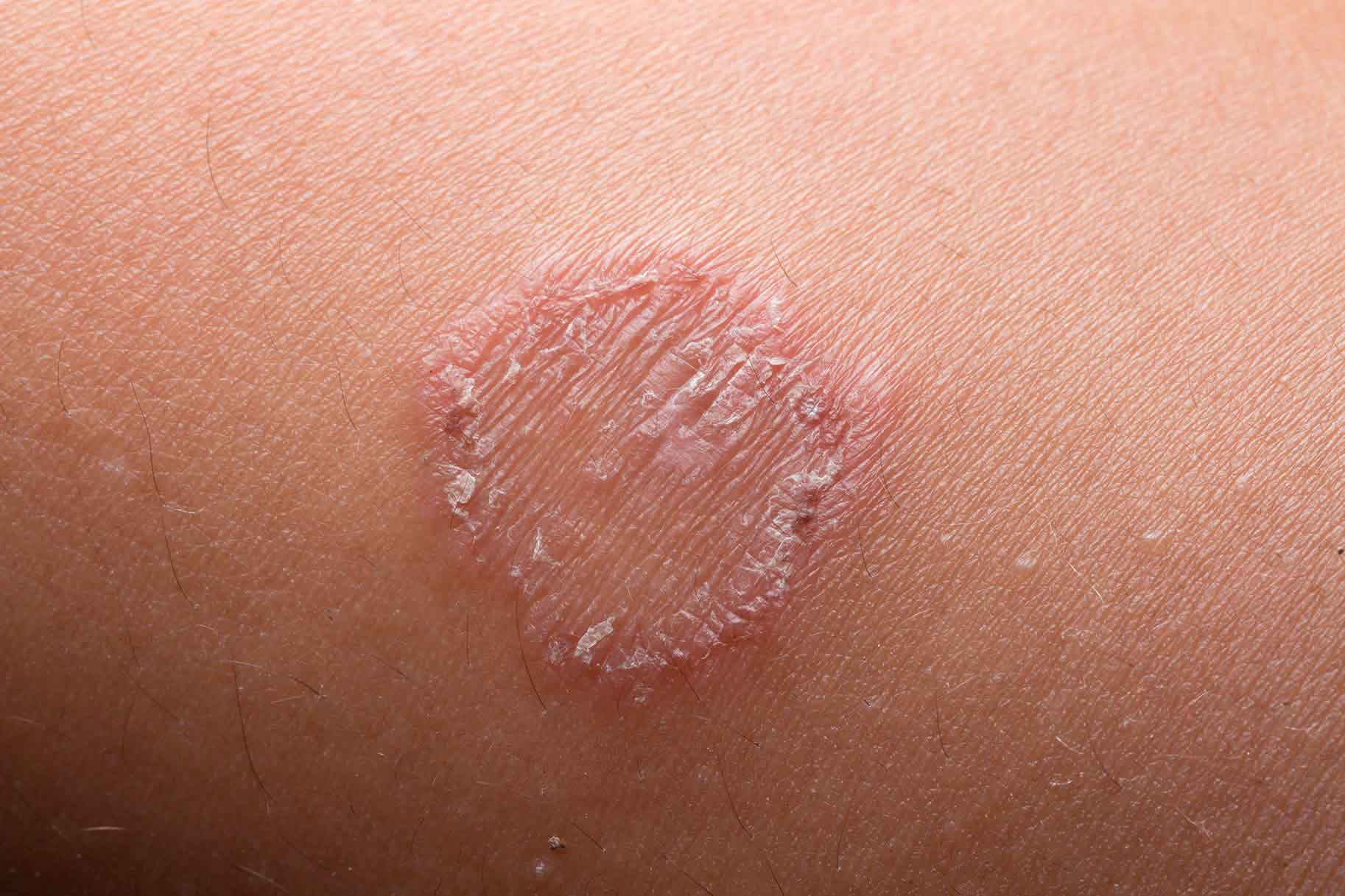 primo piano di eczema della pelle causato da tigna del corpo