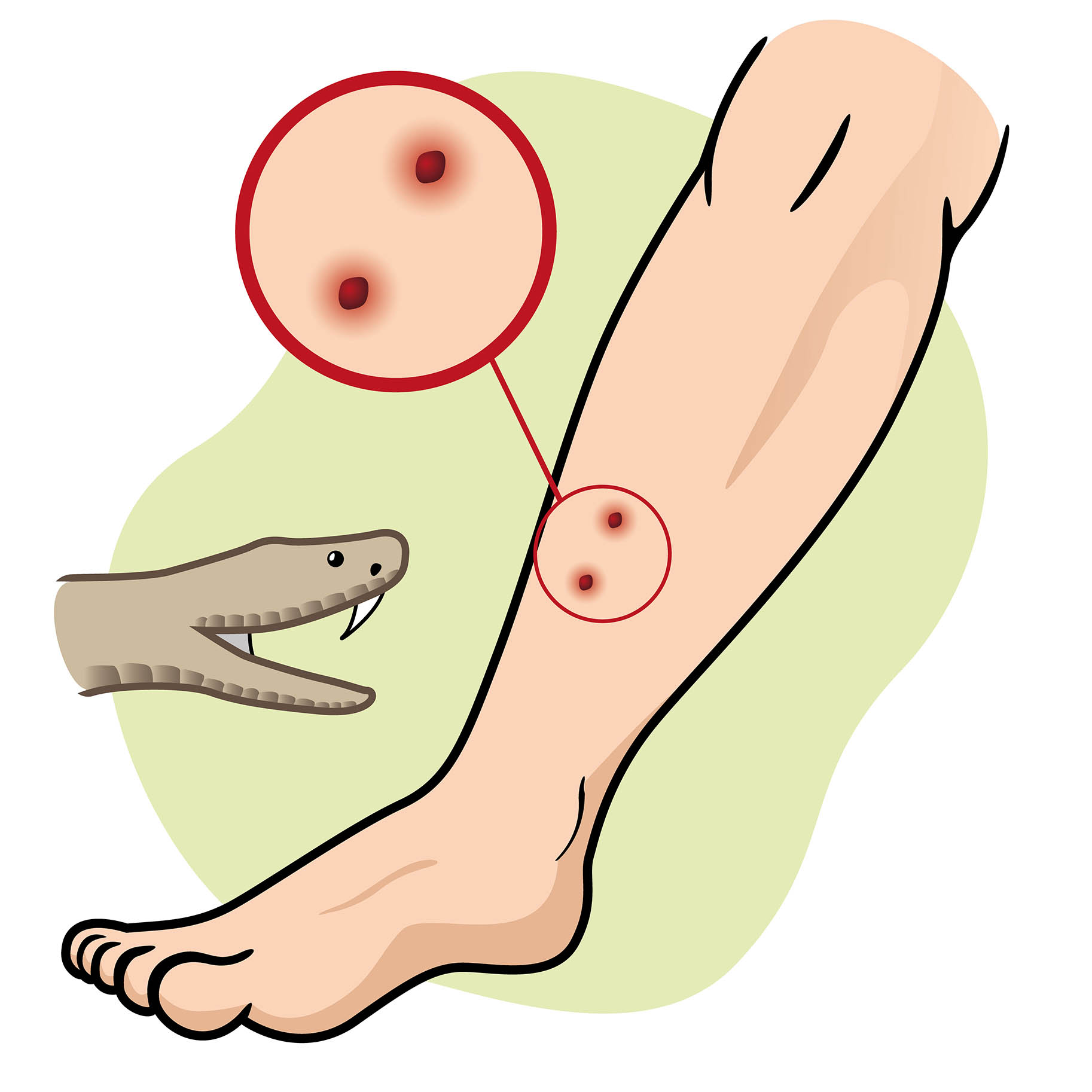 immagine che mostra le caratteristiche del morso della vipera su una gamba