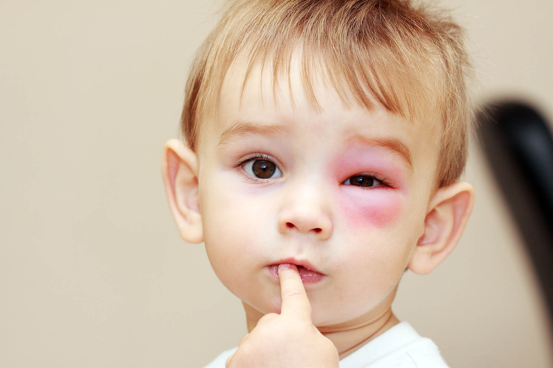 bambino con reazione allergica rigonfiamento vicino l'occhio