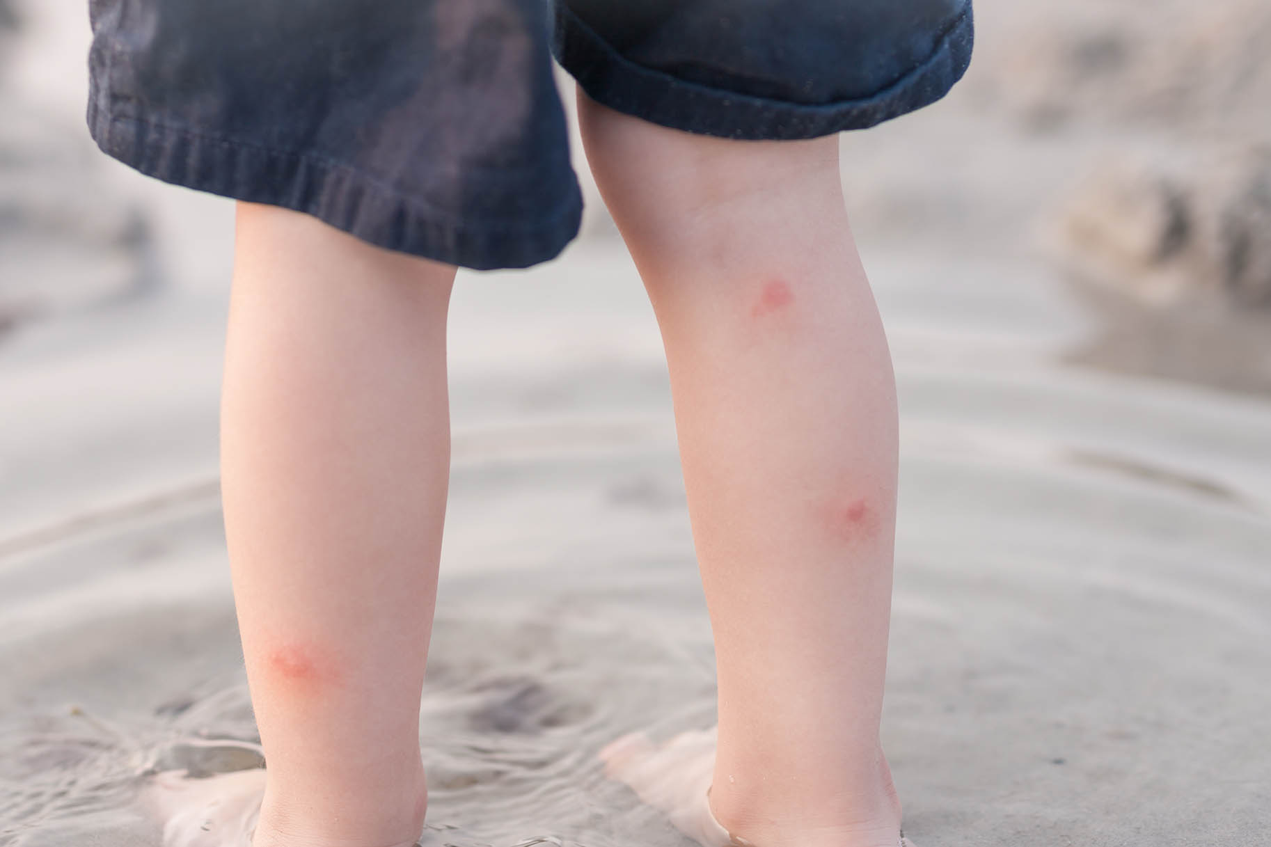 punture di zanzara sulle gambe di un bambino
