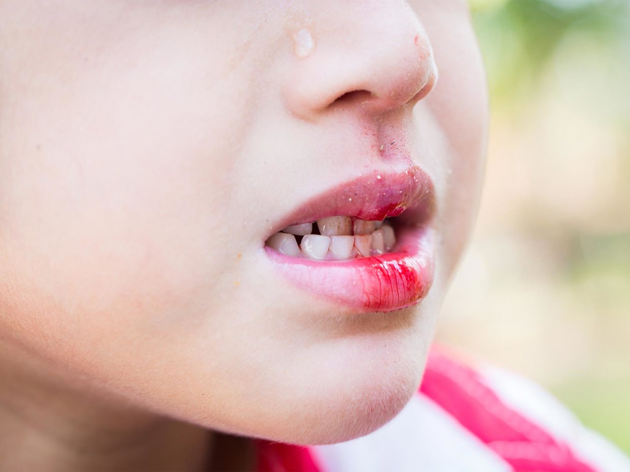 bocca di bambino con labbro sanguinante