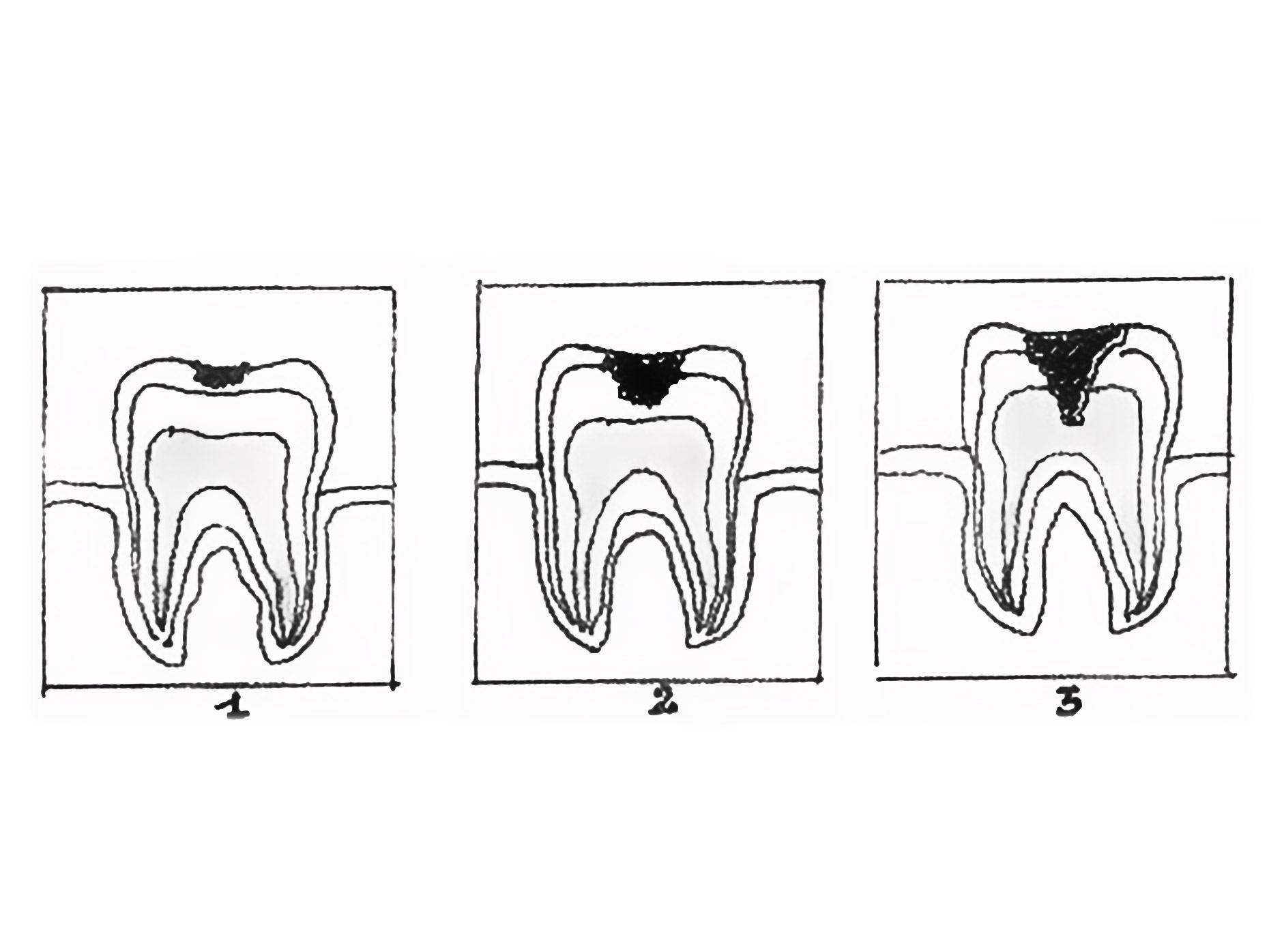 disegno che ritrae l'avanzamento delle carie nei denti