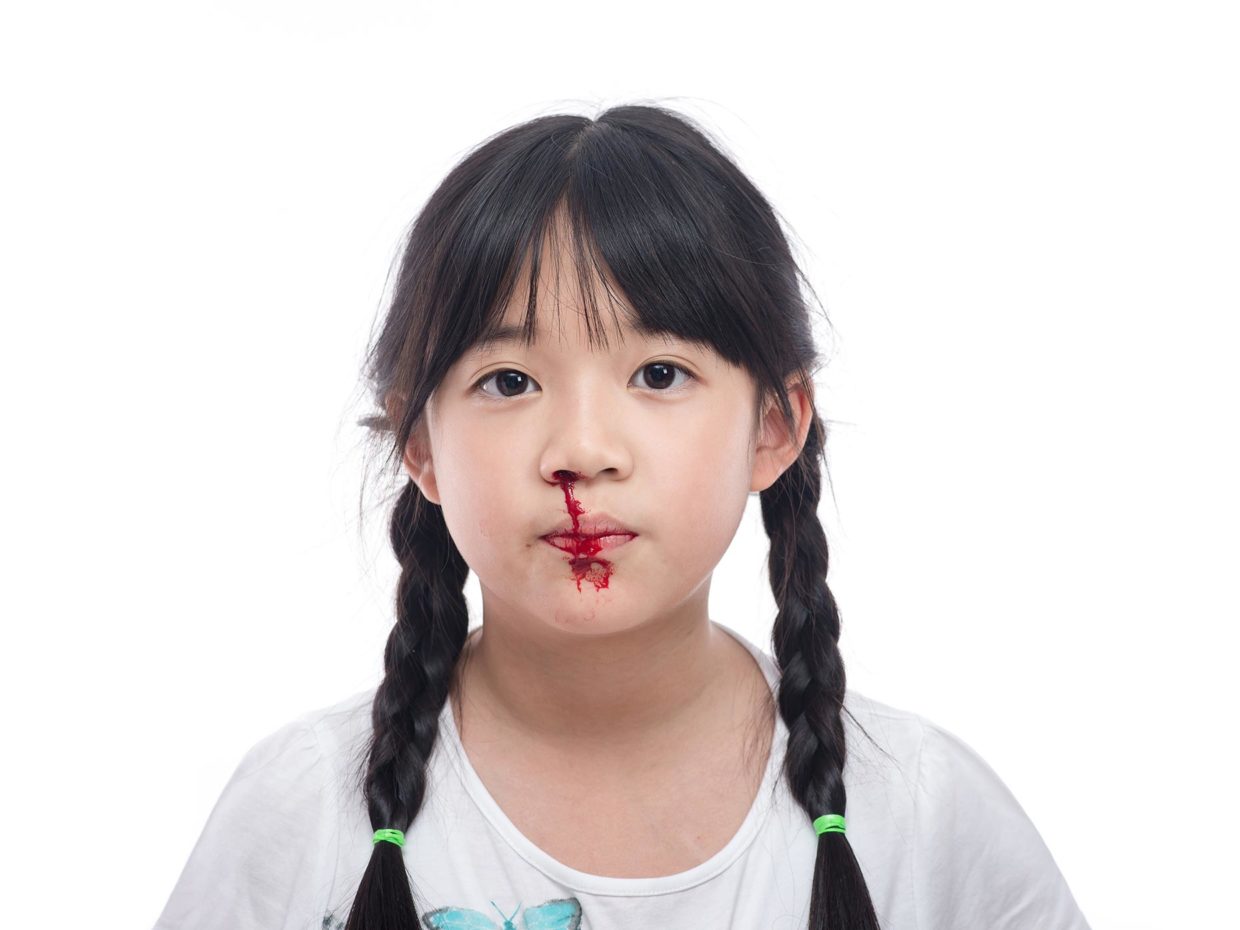 perdita di sangue dal naso di una bambina asiatica con le trecce
