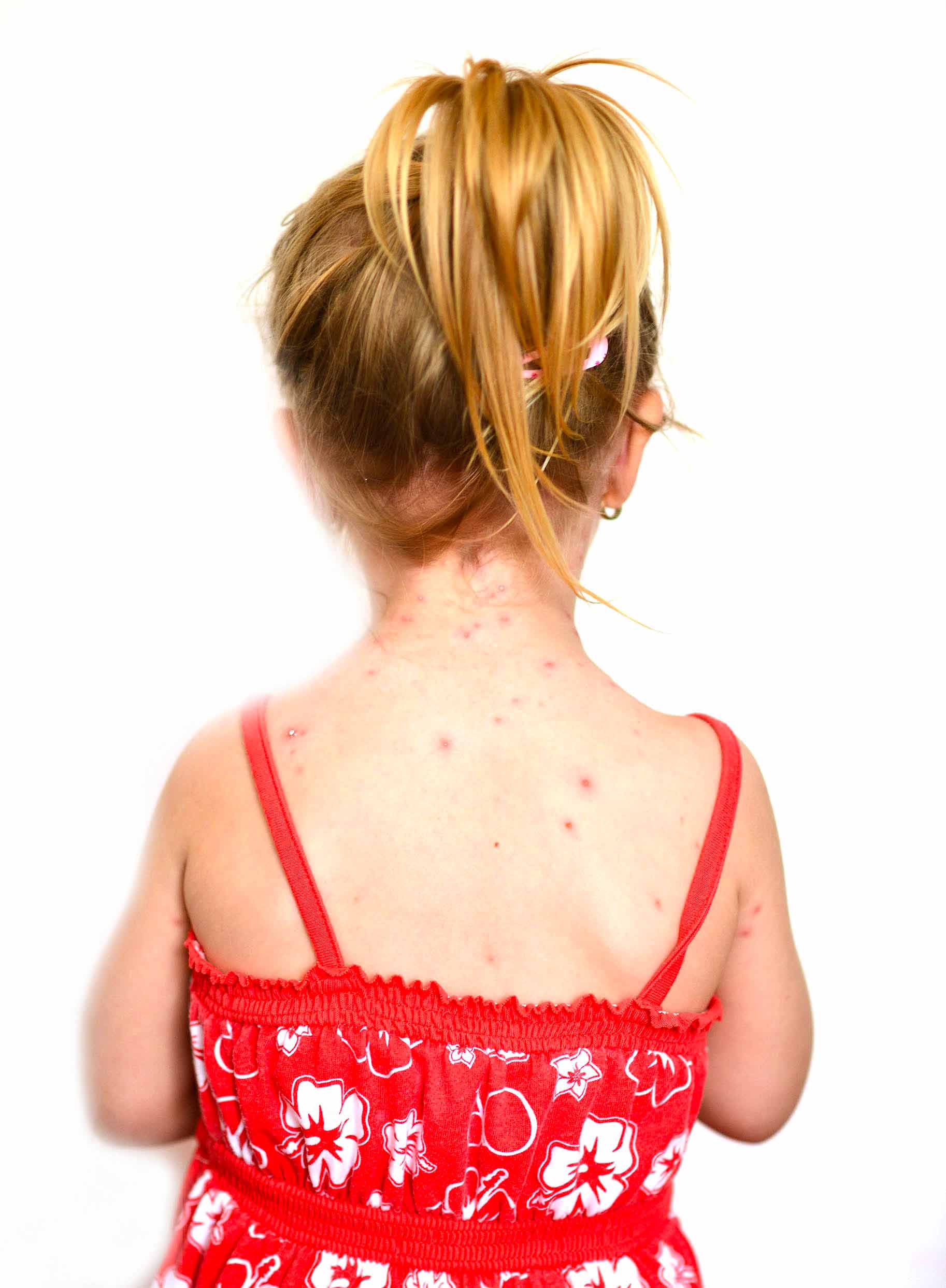schiena di bambina affetta da varicella