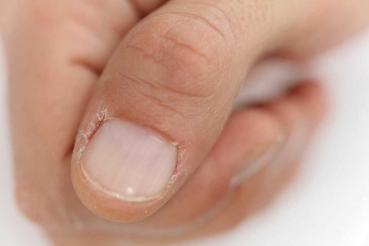 primo piano di un dito della mano di un adulto con pellicine rovinate