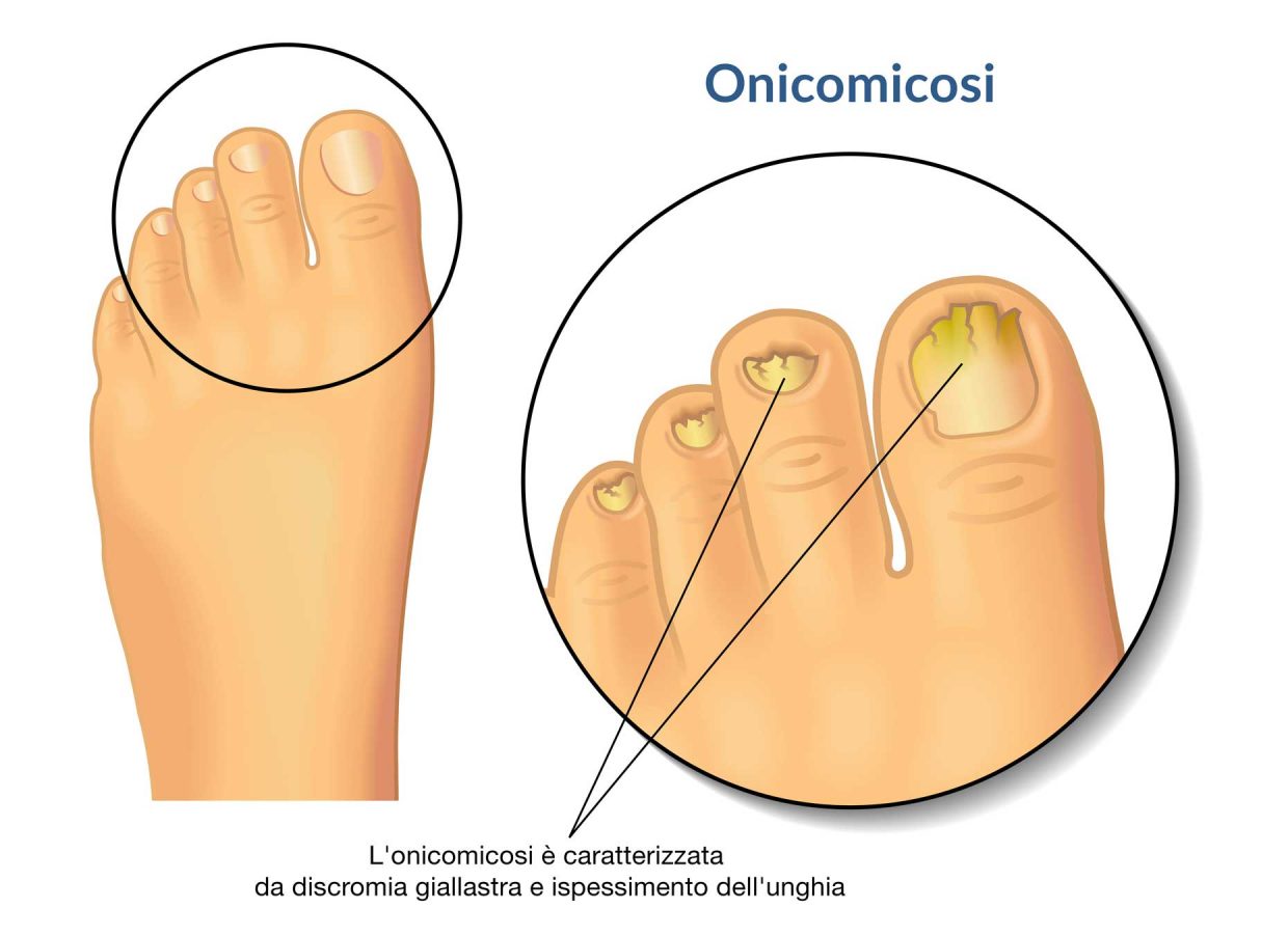 immagine descrittiva dell'onicomicosi delle unghie del piede