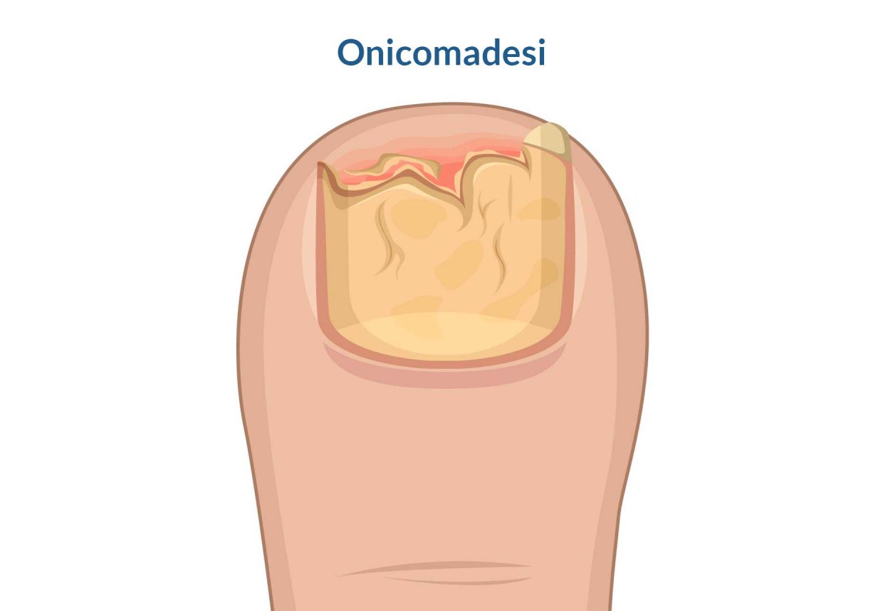immagine di unghia colpita da onicomadesi