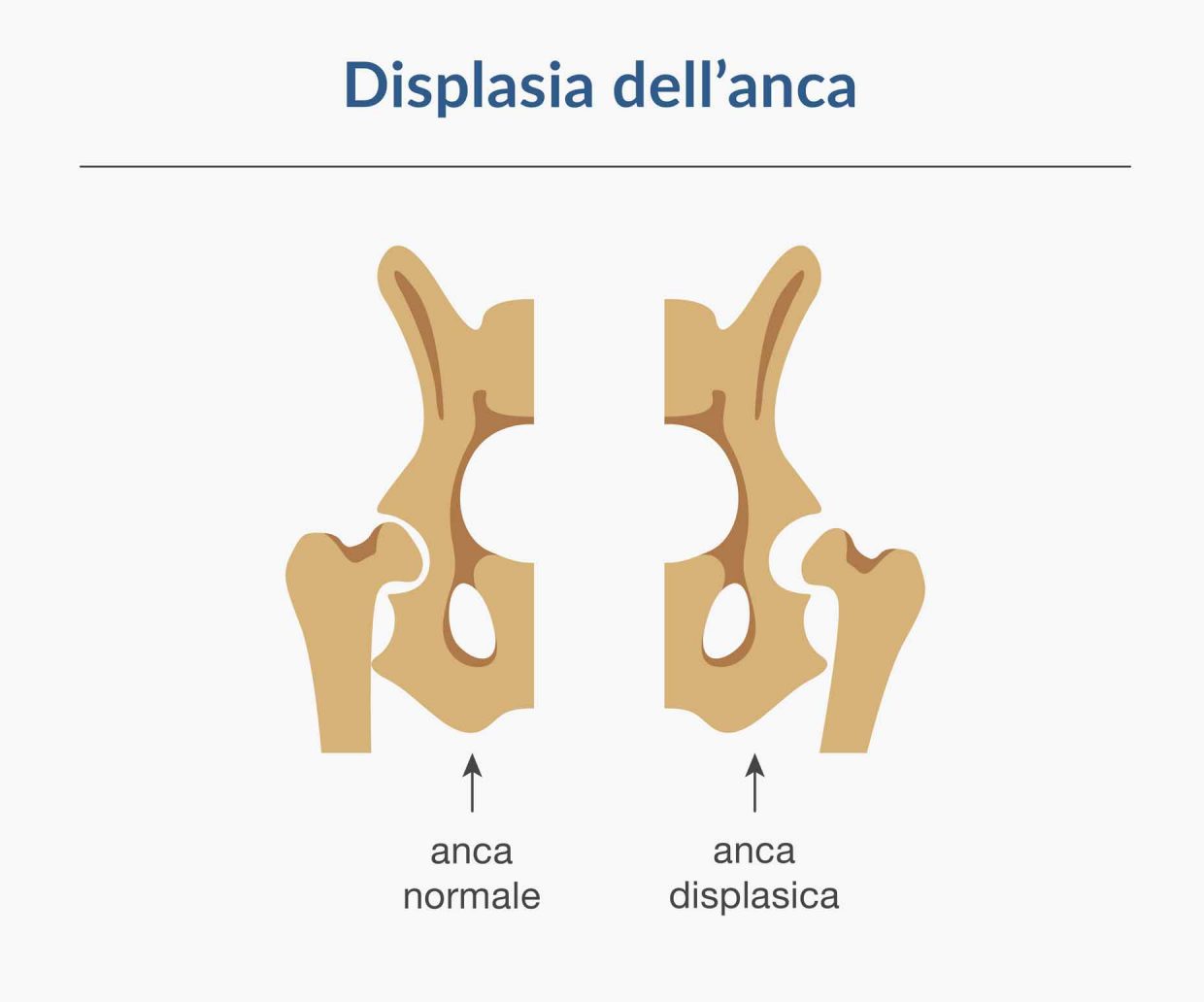 immagine che mostra la differenza delle giunzioni ossee nel caso di anca normale e anca displasica