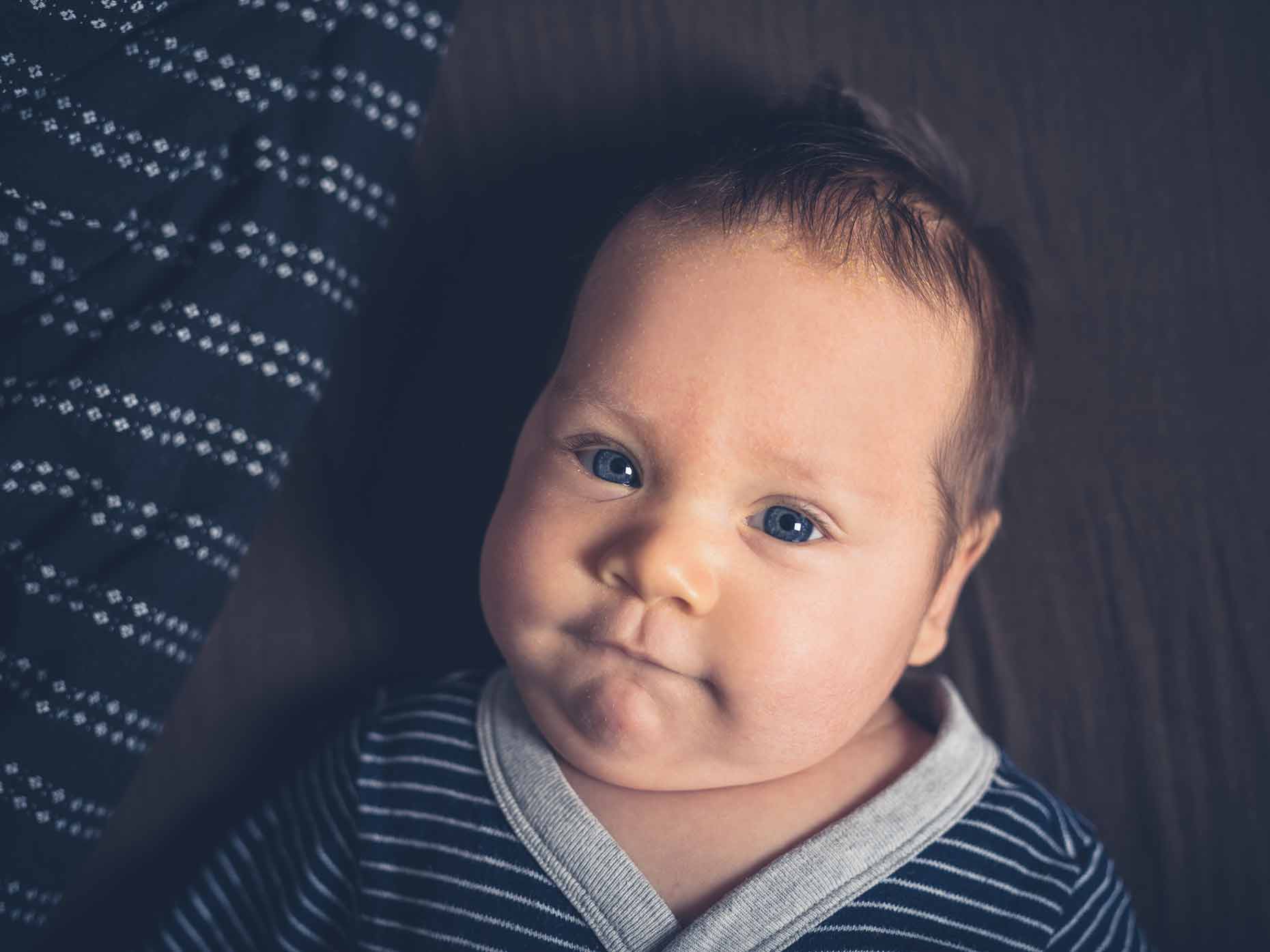 Crosta lattea nel neonato: tutto quello che c'è da sapere - Accademia  Dermatologica