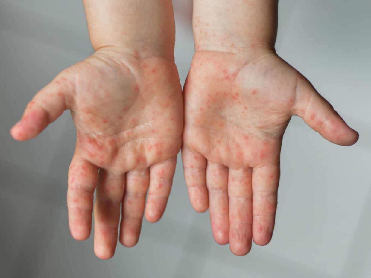 Come si manifesta la malattia mani-piedi-bocca: dettaglio delle vescicole sulle mani