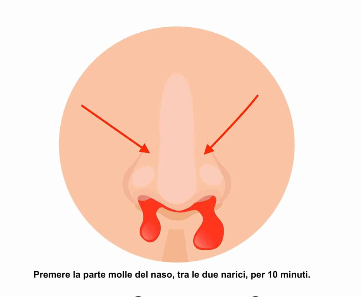 Premere la parte molle del naso tra le due narici per fermare il sangue dal naso.
