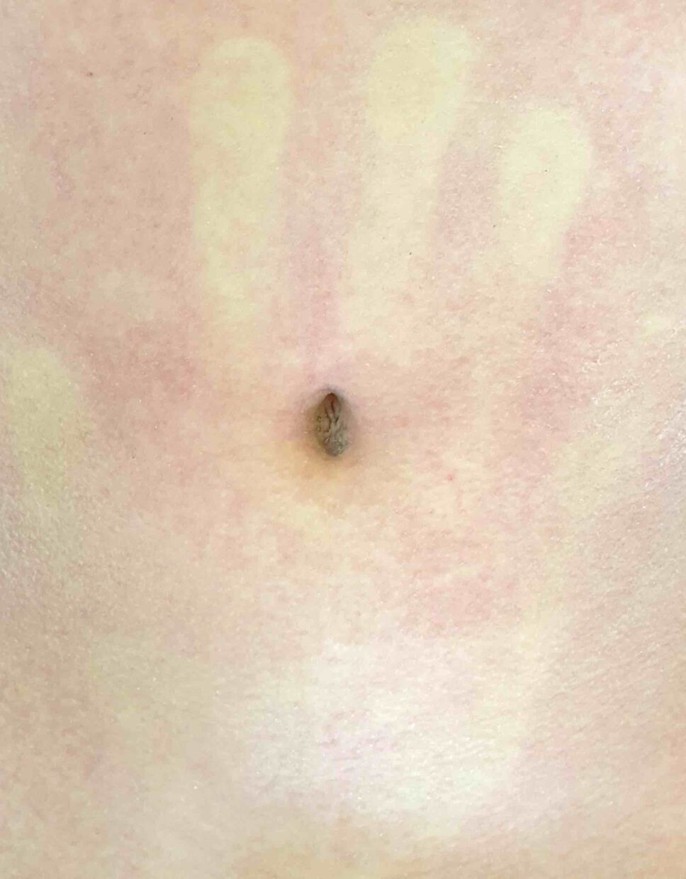Tipica impronta di "mano gialla": sintomo di scarlattina