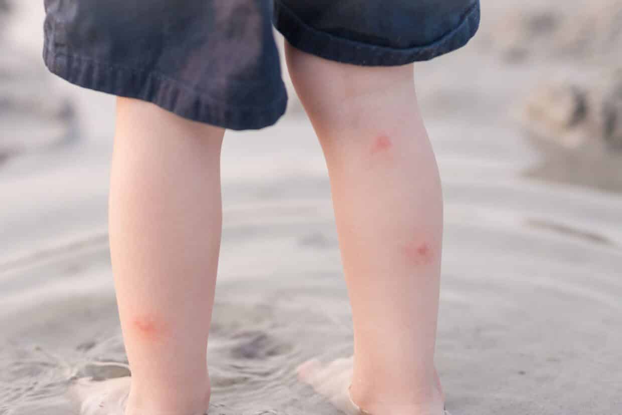 Puntura di zanzara: chiazze rosse e rilevate, molto pruriginose