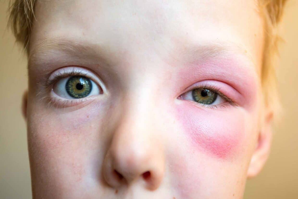 Puntura di zanzara su palpebra di bambino: palpebra e area attorno all'occhio rossa e gonfia.